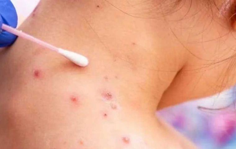 Todas las infecciones por mpox a nivel nacional pertenecían a la variante clado II