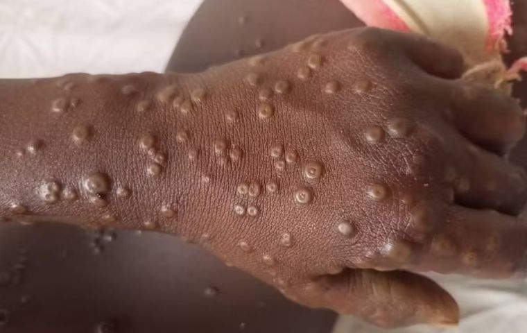 “La mpox sigue siendo una grave emergencia de salud pública en África”, advirtió el director de CDC África