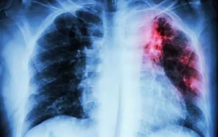 La tuberculosis y la Covid-19 son enfermedades respiratorias con síntomas similares