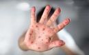 La varicela, causada por el virus varicela-zóster, es altamente contagiosa