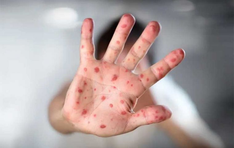 La varicela, causada por el virus varicela-zóster, es altamente contagiosa