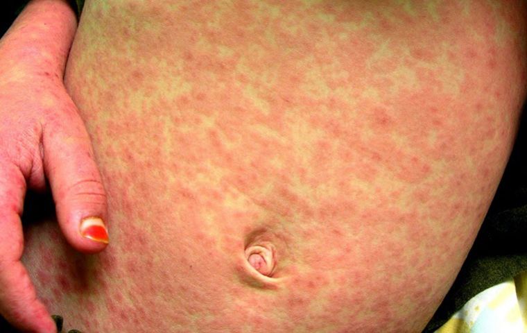 Los viajeros que regresan de Europa o Estados Unidos deben estar atentos a los s&iacute;ntomas respiratorios